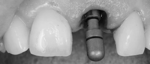 azonnali implantáció képe