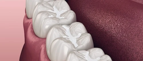 Barázdazárás készítése