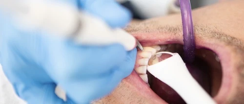 Fogínygyulladás kezelése