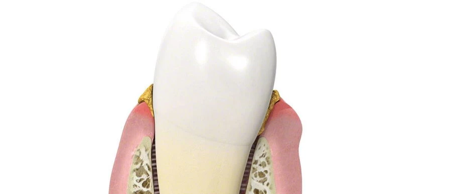 Fogkő eltávolítás, ínygyulladás kezelése