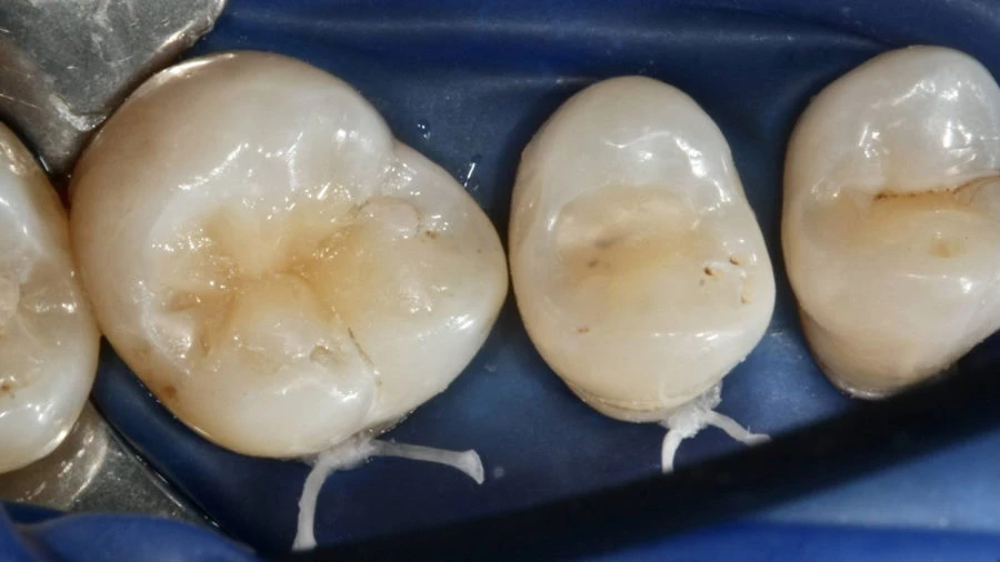 Fogtömés lépései