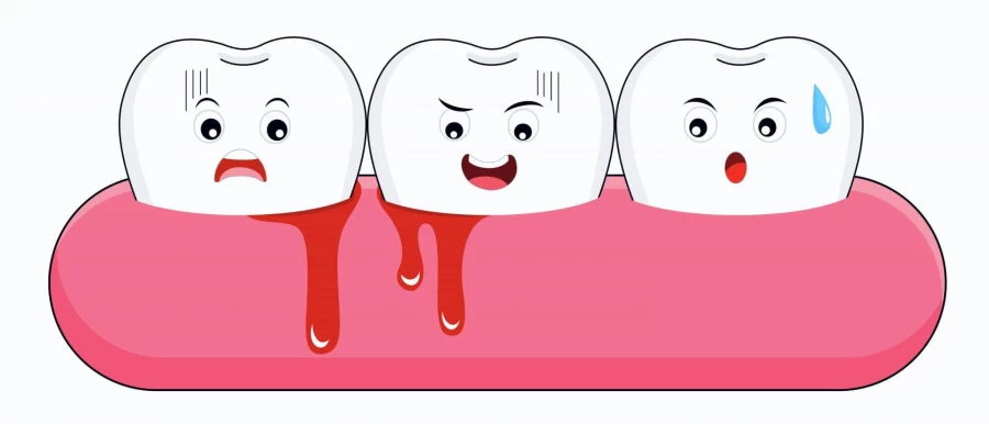 Vérző íny grafika