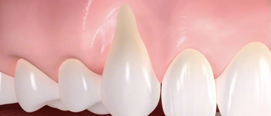 Ínyvisszahúzódás