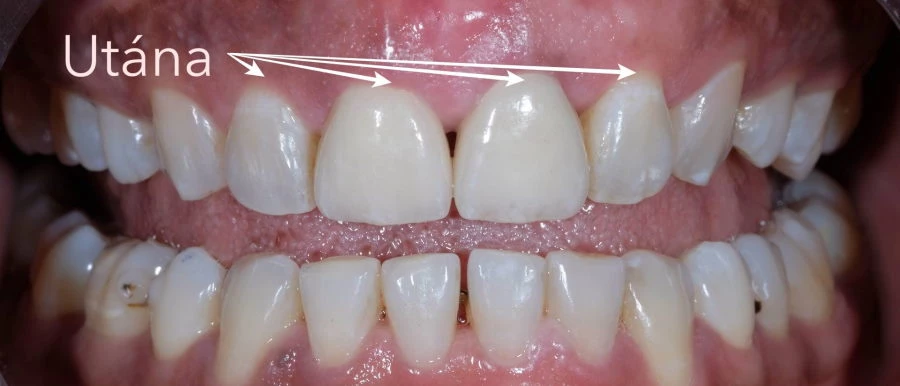 Koronahosszabbító műtét után