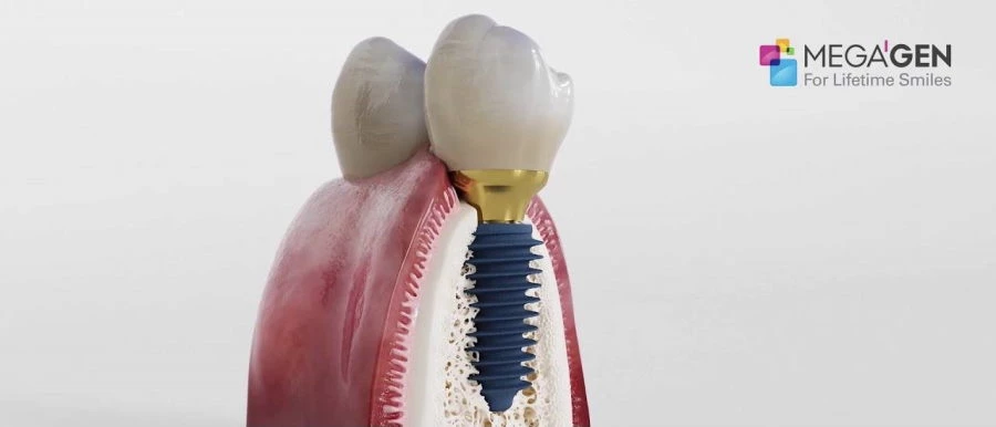 Megegan fogbeültetés