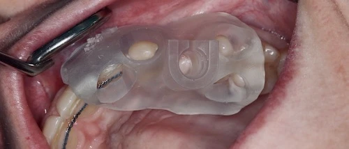 Megagen R2Gate navigált implantáció